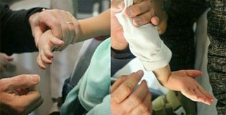 پیوند عصب دست با چسب بیولوژیک